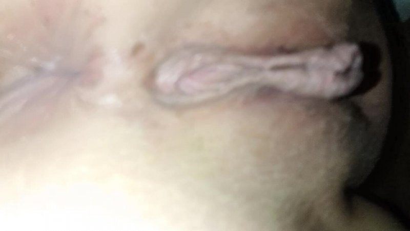 Watch Cherwhite one year after adult scoliosis surgery — 10:08 adult clip